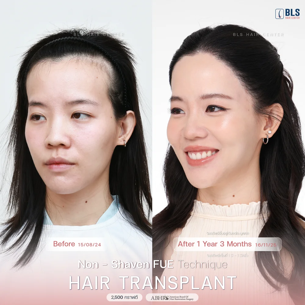 คลินิก ปลูกผม Hair Transplant BLS Hair Center