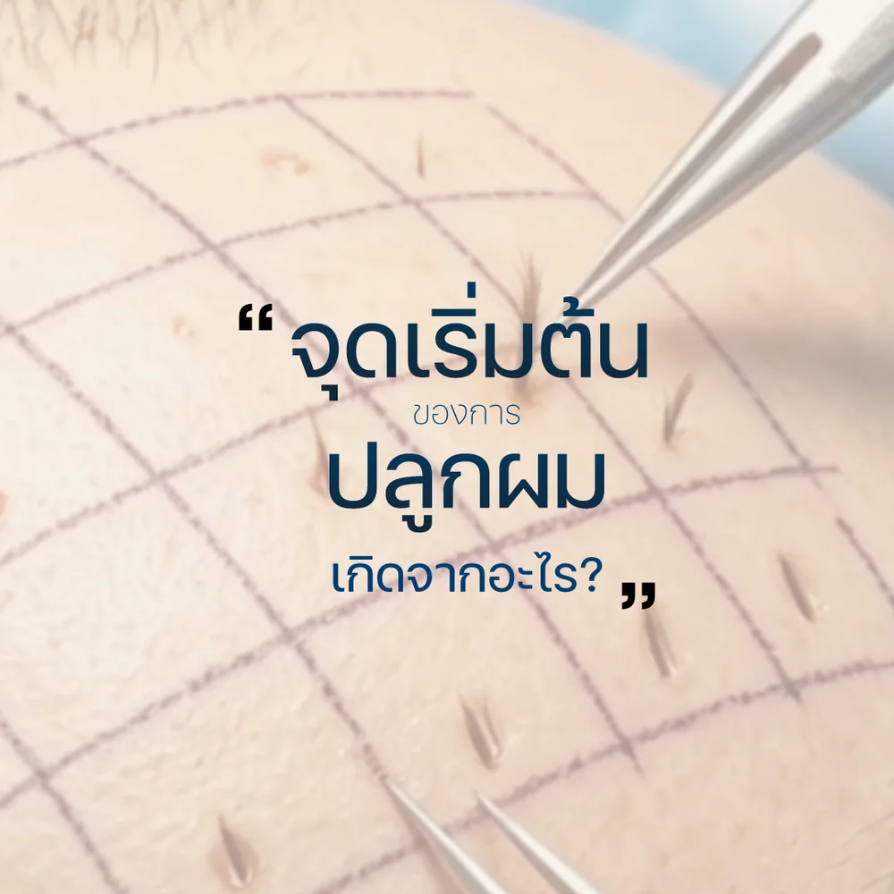 จุดเริ่มต้นของการปลูกผมเกิดจากอะไร?
