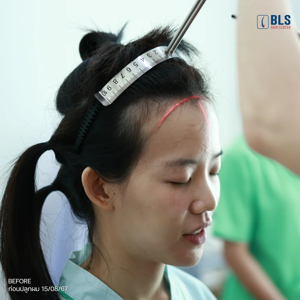 เทคนิคปลูกผม Non-Shaven FUE (ปลูกผมไม่ต้องโกน)