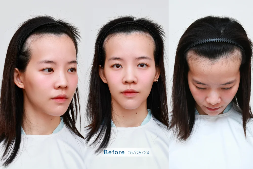 รีวิวปลูกผมผู้หญิง กับหมอบี ปลูกผม อเมริกันบอร์ด ที่ BLS Hair Center