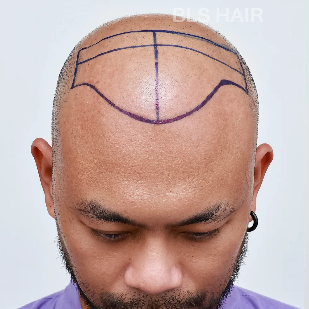Follicular Unit Extraction (FUE) is a hair transplant technique to address hair loss, thinning hair, and baldness.