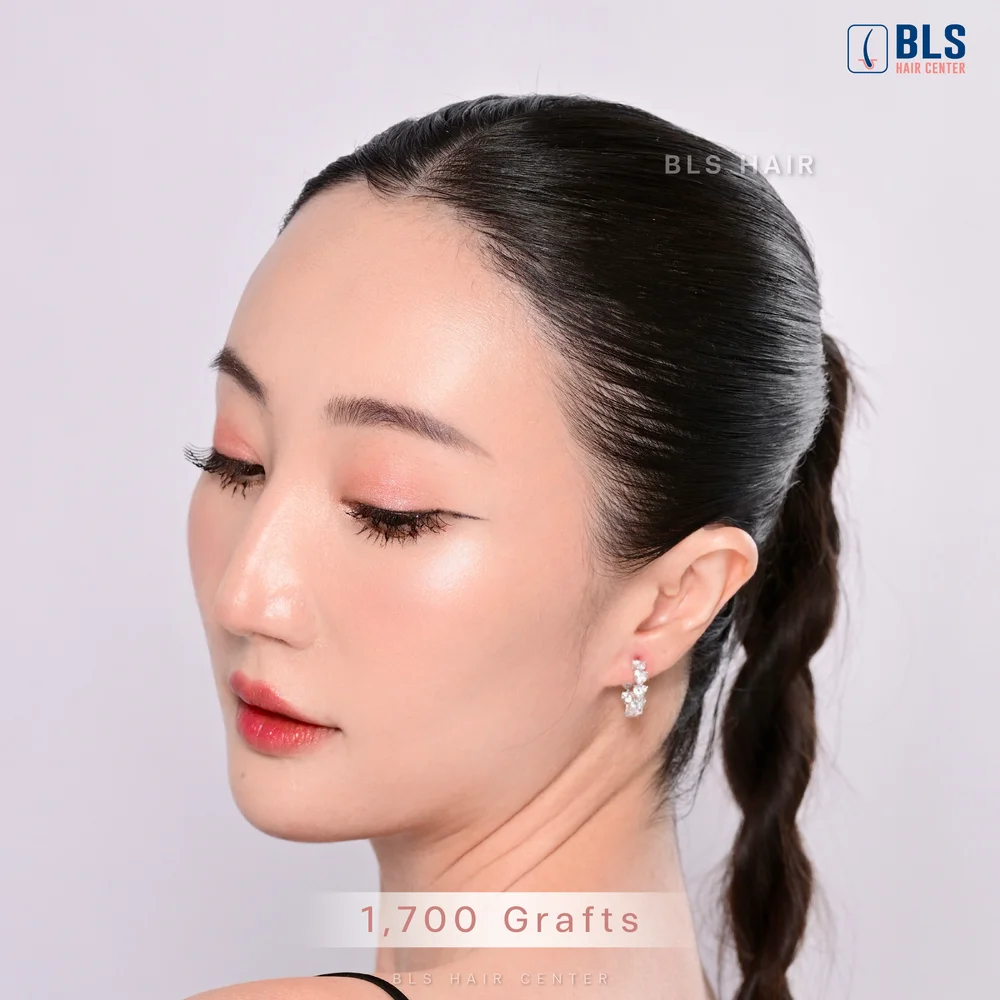 หลังปลูกผมผู้หญิง Female Hairline ผลลัพธ์แก้ปัญหาเส้นผม 6 เดือน ที่ BLS Hair Center