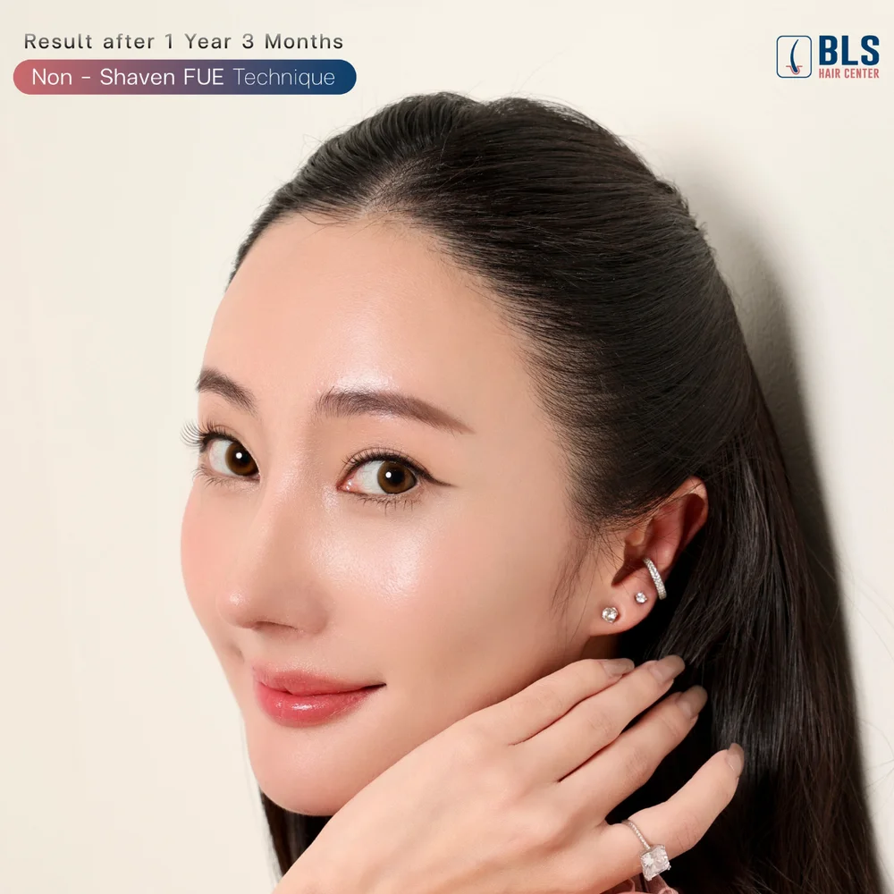 หลังปลูกผมผู้หญิง Female Hairline ผลลัพธ์แก้ปัญหาเส้นผม 1 ปี ที่ BLS Hair Center