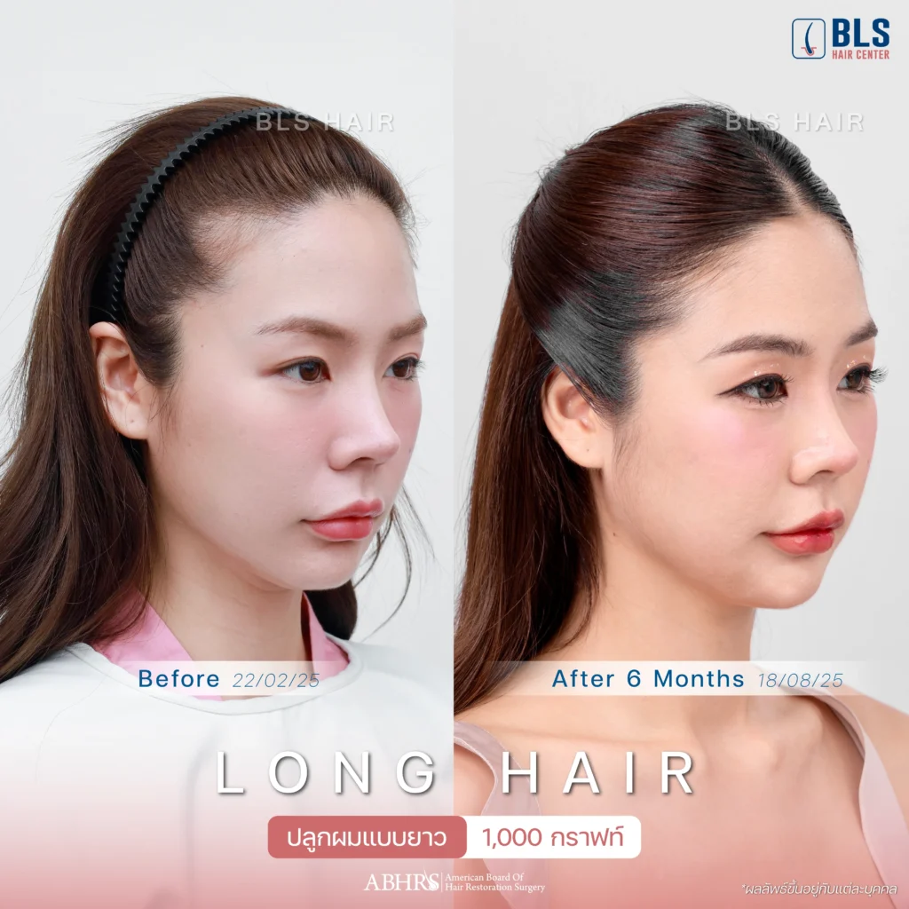ผลลัพธ์หลังปลูกผมผู้หญิง ด้วยเทคนิค Non-Shaven FUE