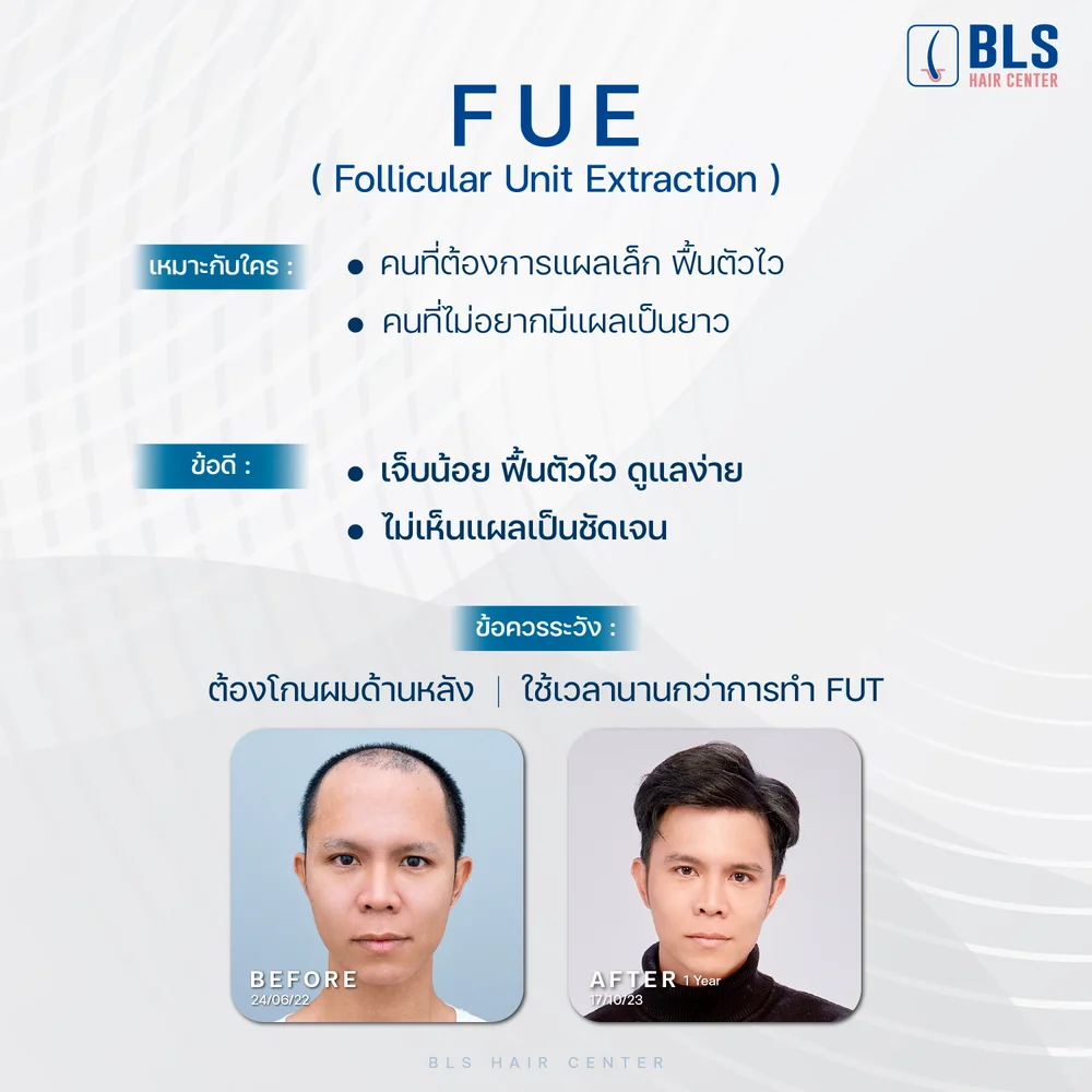 ปลูกผม FUE โดยหมอปลูกผมอเมริกันบอร์ด ABHRS ที่ BLS Hair Center