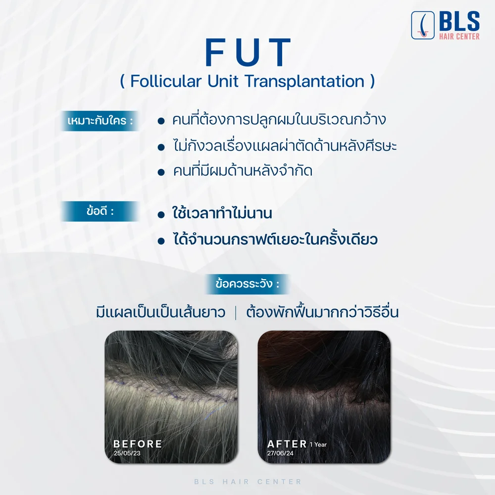 ปลูกผม FUT (Follicular Unit Transplantation)