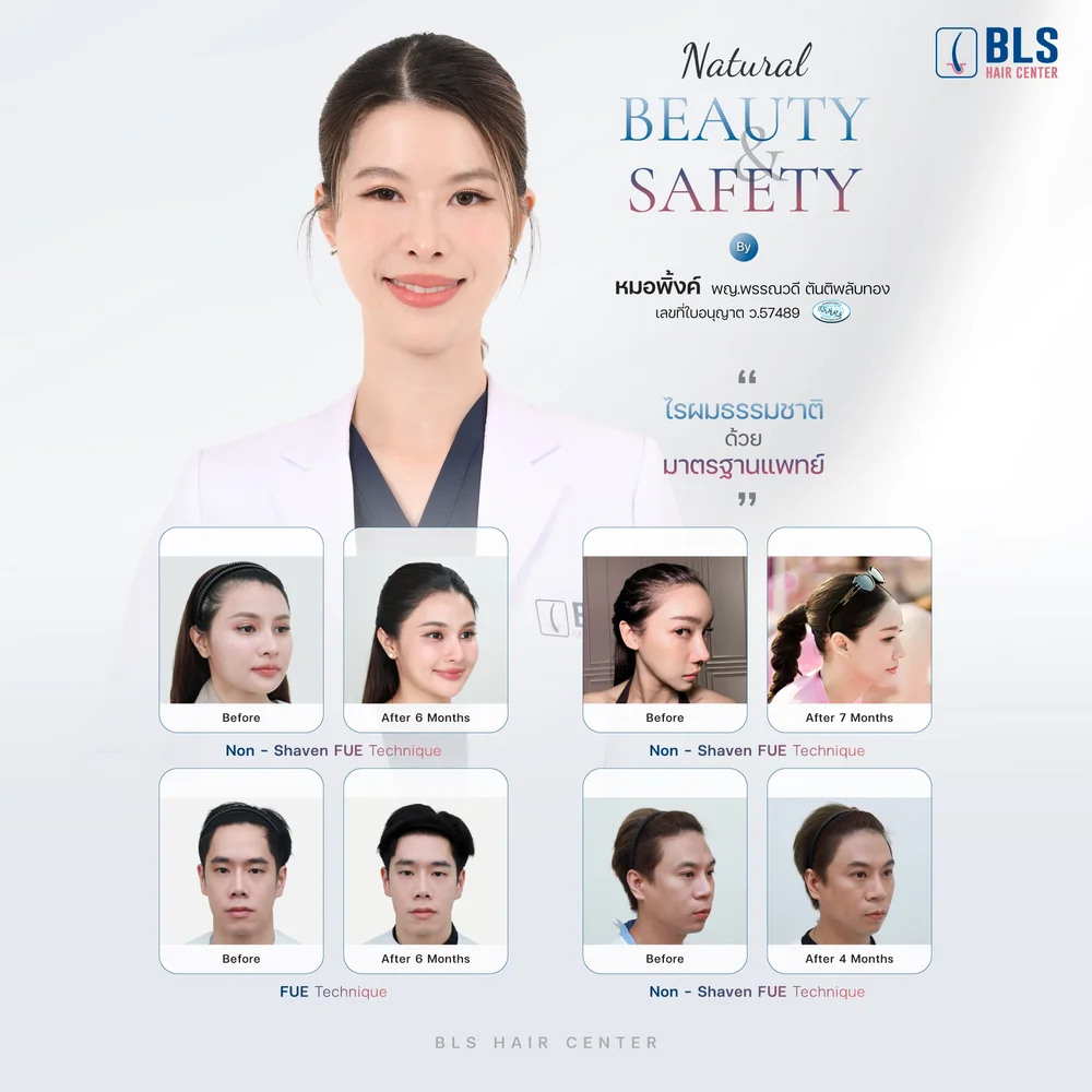 รีวิวปลูกผมผู้หญิง ช่วยปรับกรอบหน้าให้ดูละมุนขึ้น