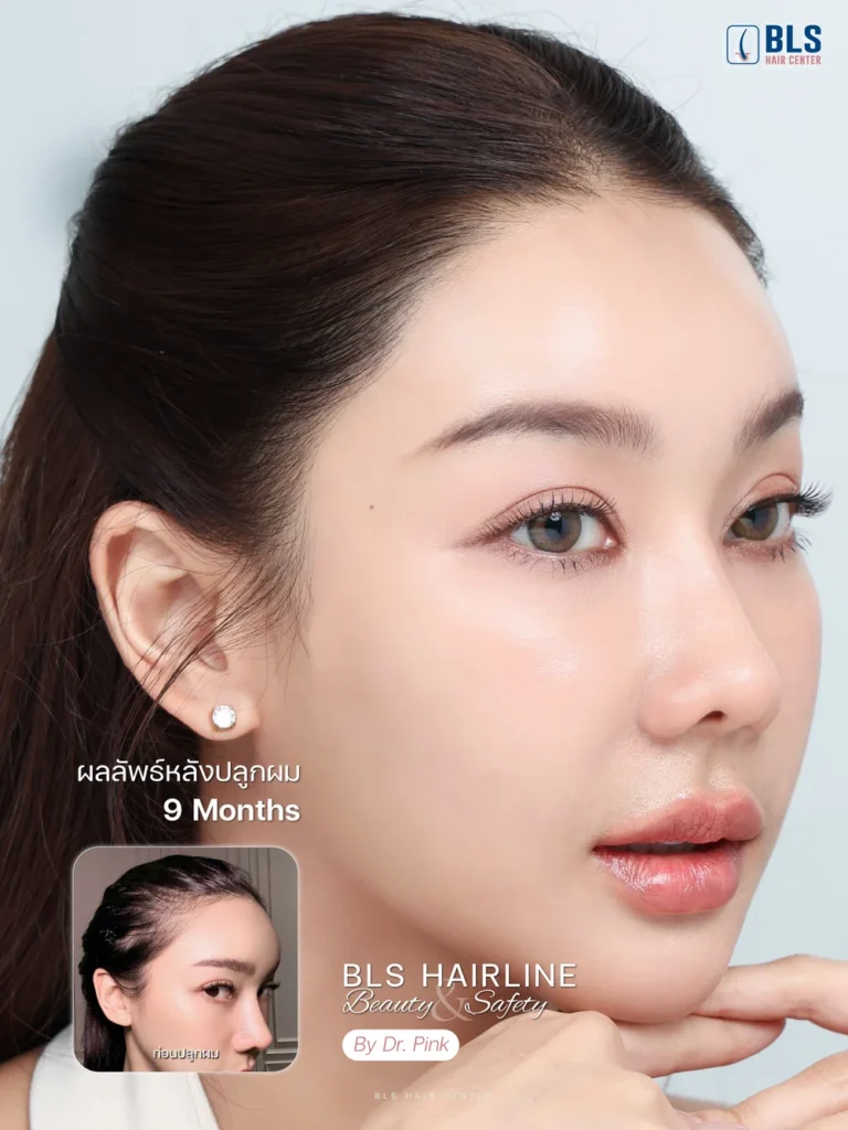 รีวิวปลูกผมผู้หญิง แนวไรผมเป็นธรรมชาติแบบ BLS Hairline