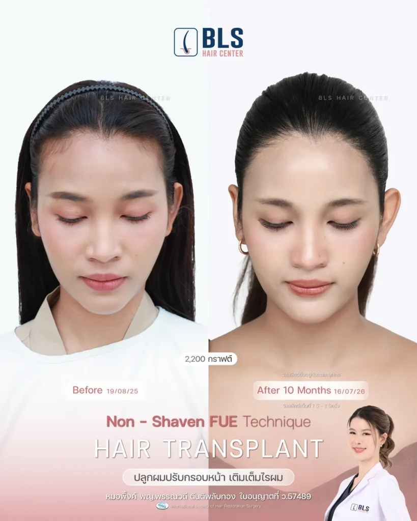 รีวิวปลูกผมผู้หญิง ปรับกรอบหน้า แนวไรผมธรรมชาติ