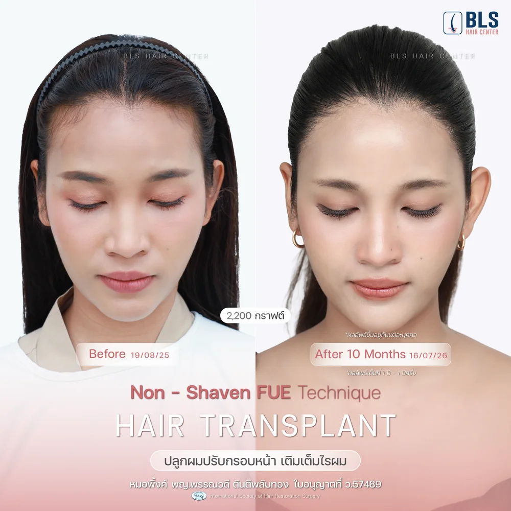 รีวิวปลูกผมผู้หญิง ปรับกรอบหน้า แนวไรผมธรรมชาติ