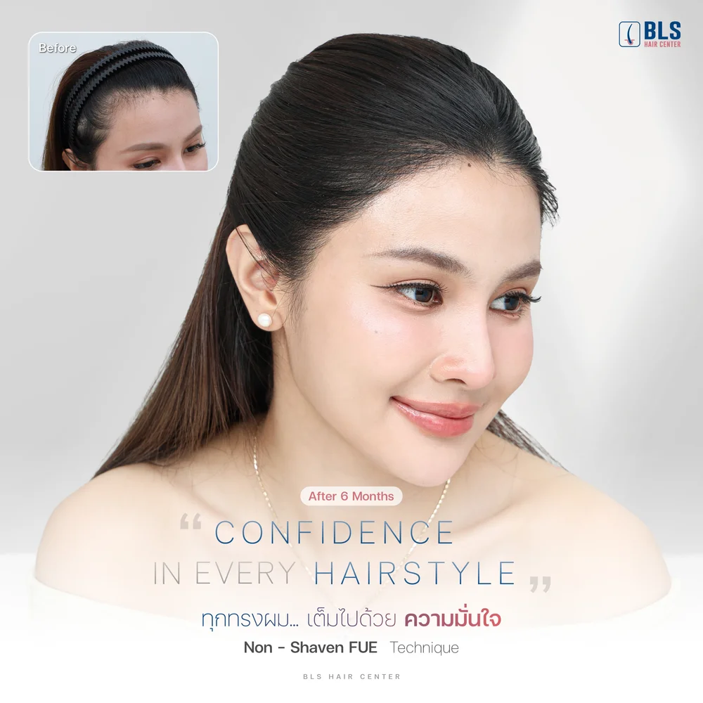 ปลูกผมปรับกรอบหน้า ด้วยเทคนิค Non-Shaven FUE