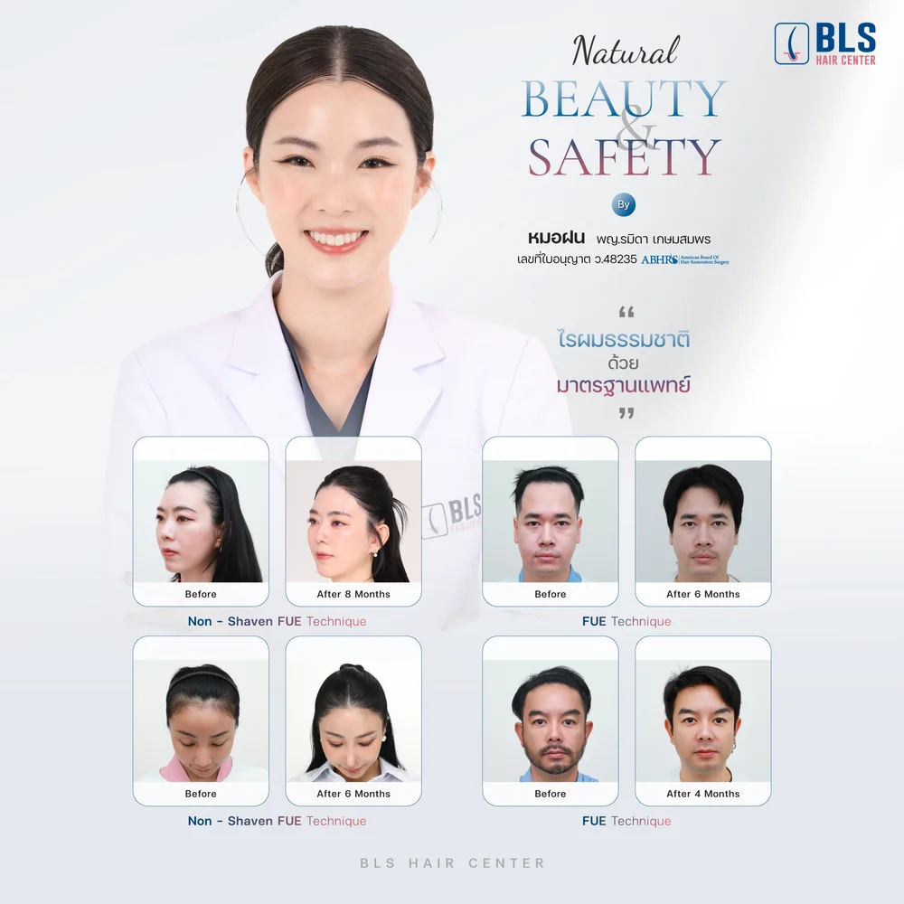 รีวิวปลูกผม Non-Shaven FUE ช่วยเพิ่มความหนาแน่นของแนวผม