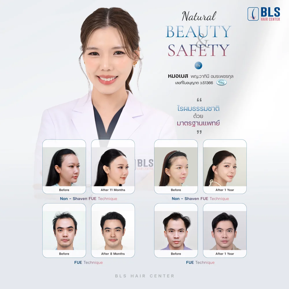 รีวิวปลูกผมถาวร Hairline Design ช่วยปรับแนวไรผมให้เหมาะกับรูปหน้า