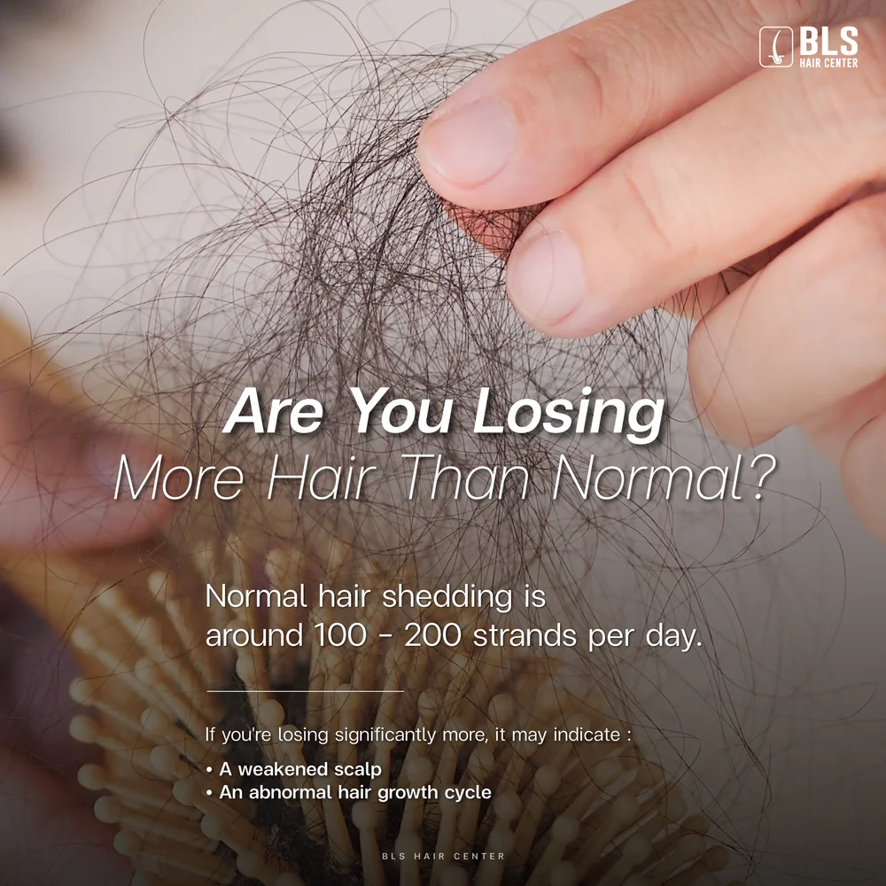 What Causes Hair Loss? Does Hereditary Baldness Play a Role?