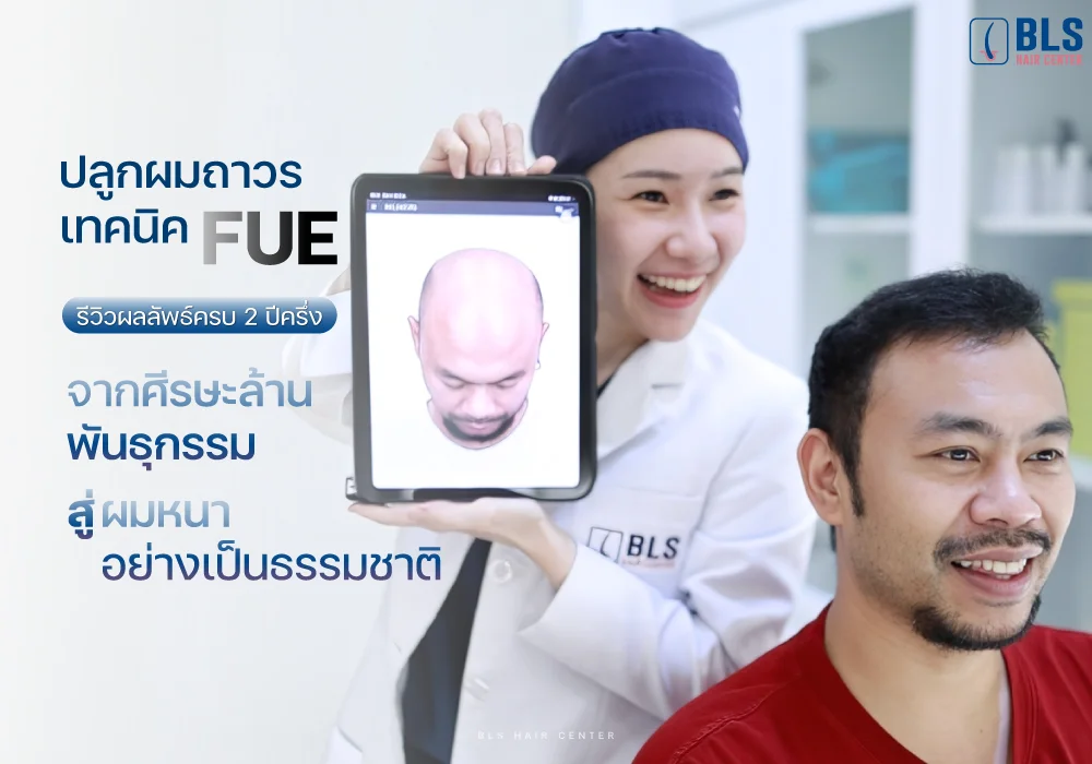ปลูกผม FUE รีวิวผลลัพธ์ครบ 2 ปีครึ่ง จากศีรษะล้านพันธุกรรม สู่ผมหนาเป็นธรรมชาติ