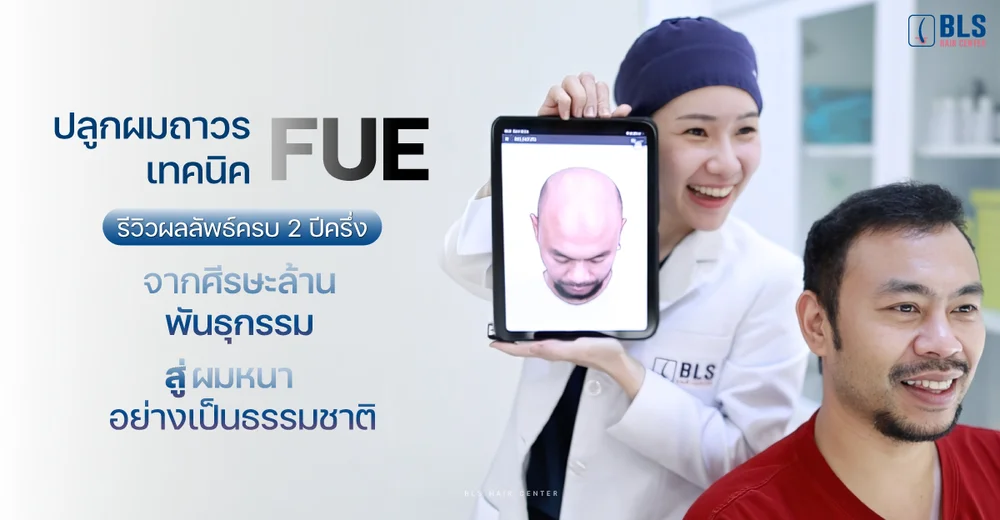 ปลูกผม FUE รีวิวผลลัพธ์ครบ 2 ปีครึ่ง จากศีรษะล้านพันธุกรรม สู่ผมหนาเป็นธรรมชาติ