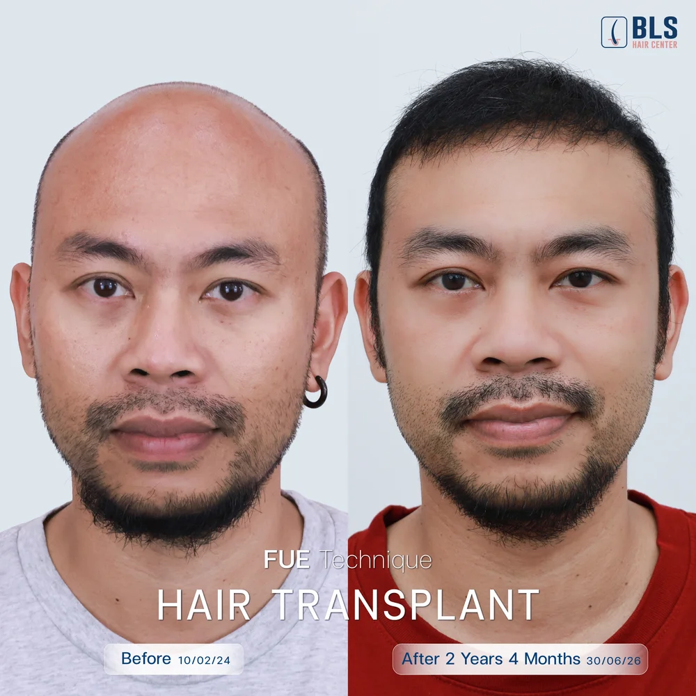 ปลูกผม FUE ผู้ชาย ดีไหม เทคนิคการปลูกผมแบบไหนดีที่สุด?