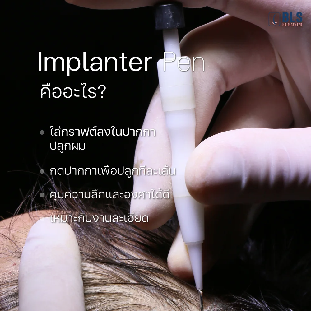 Implanter Pen คืออะไร ปลูกผม DHI กับ FUE ต่างกันยังไง