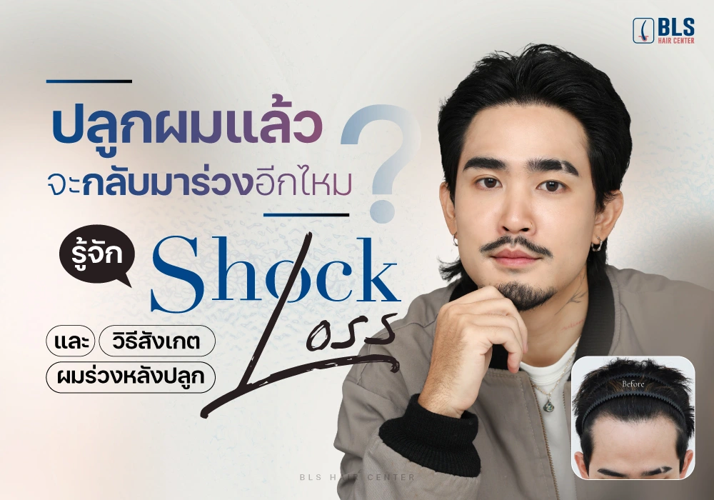 ปลูกผมแล้วจะกลับมาร่วงอีกไหม?รู้จัก Shock Loss และวิธีสังเกตผมร่วงหลังปลูก