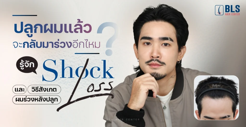 ปลูกผมแล้วจะกลับมาร่วงอีกไหม?
รู้จัก Shock Loss และวิธีสังเกตผมร่วงหลังปลูก