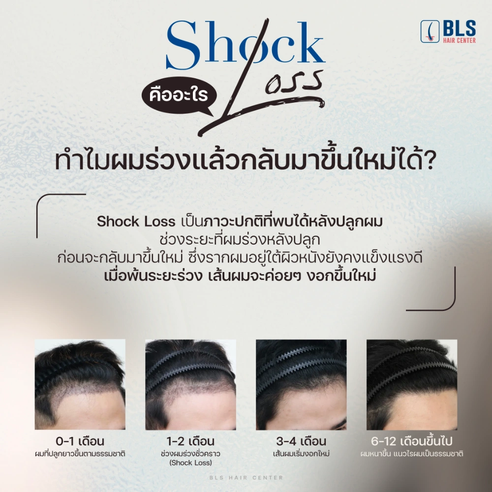 ปลูกผมอยู่ได้นานไหม Shock Loss คืออะไร