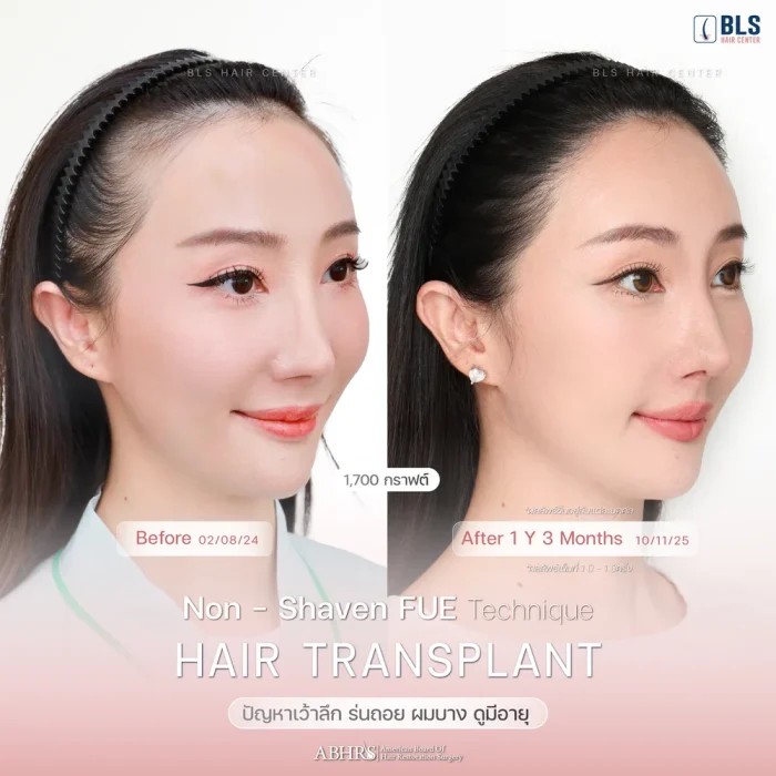ปลูกผมไม่ต้องโกน Non Shaven FUE เหมาะกับใคร?