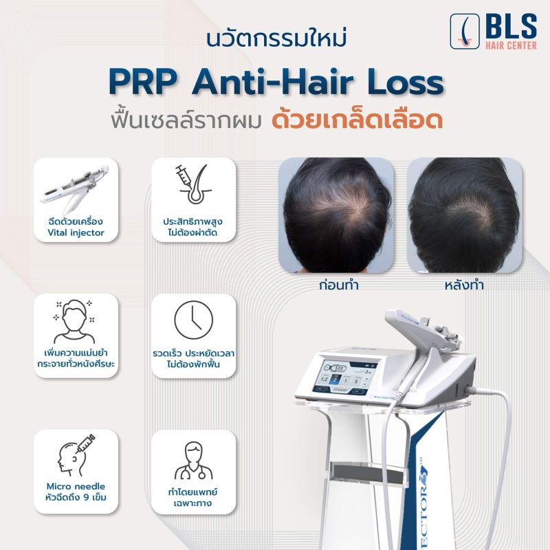 New innovation PRP Anti-Hair Loss นวัตกรรมใหม่ PRP Anti-Hair Loss | ทํา PRP ผม