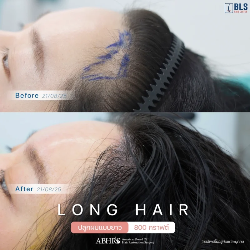 ปลูกผมยาว เทคนิค Long Hair คืออะไร