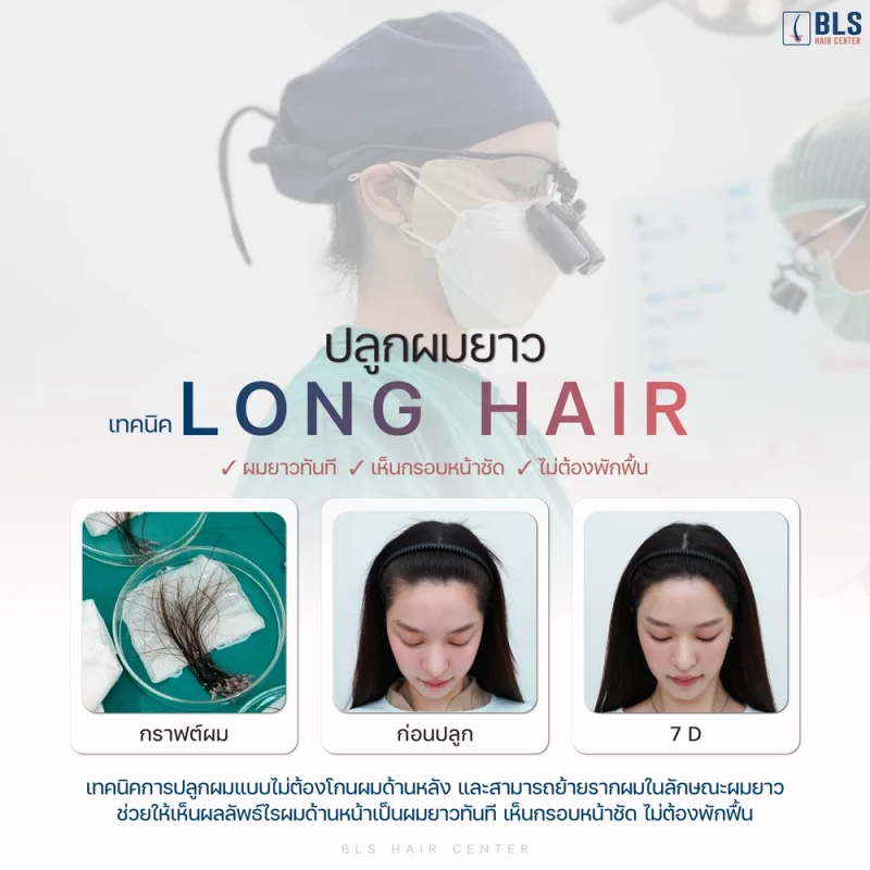 ปลูกผมยาว เทคนิค Long Hair คืออะไร